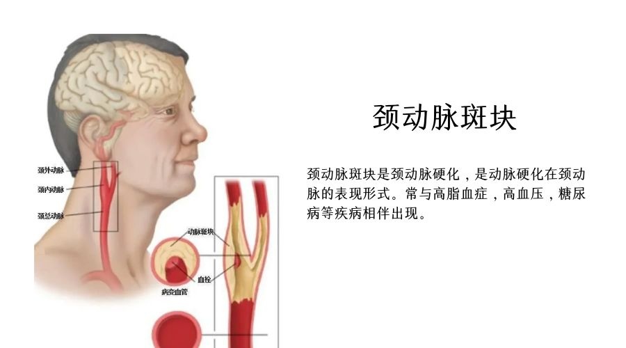易愛(ài)科普｜成年人1/3都存在的頸動(dòng)脈斑塊究竟是什么？